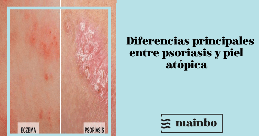 psoriasis